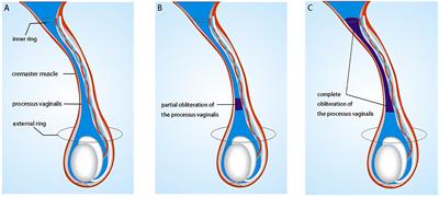 Comparison of the Detection and Ligation of Patent Processus Vaginalis Between Laparoscopy-Assisted Transscrotal Orchiopexy and Single Scrotal Incision Orchiopexy